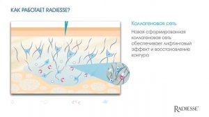 Векторный лифтинг Radiesse (Радиесс)