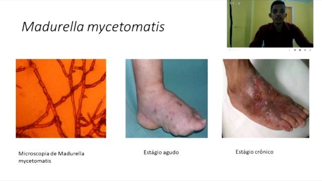 Doença Micetoma/ Eumicetoma смотреть онлайн