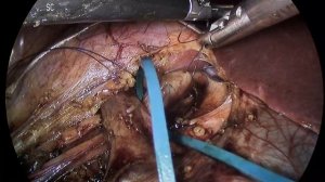 Лапароскопическая коррекция гидронефроза. Пластика лоханочно-мочеточникового сегмента правой почки.