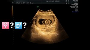 How is fetal gender determined on ultrasound. 14th week in the womb. Guess: Is it a boy or a girl?