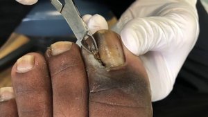 Fleshy Ingrown Toenail Removal 2 Weeks Later