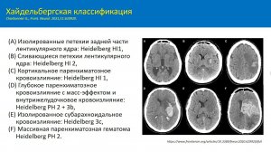 Геморрагические внтуричерепные осложнения на фоне антитромботической терапии