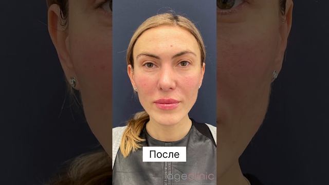 До и после процедуры FULLFACE