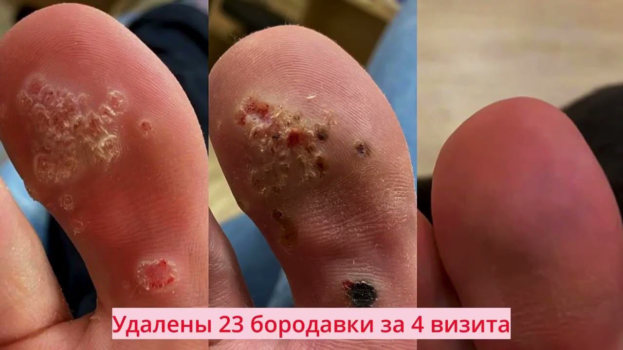 Удаление бородавок, папиллом и криомассаж, лечение акне, розацеа и аллопеции!