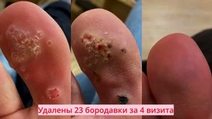 Удаление бородавок, папиллом и криомассаж, лечение акне, розацеа и аллопеции!