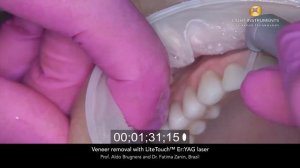 Удаление винира с помощью лазера LiteTouch™ Er:YAG (обратный отсчет)