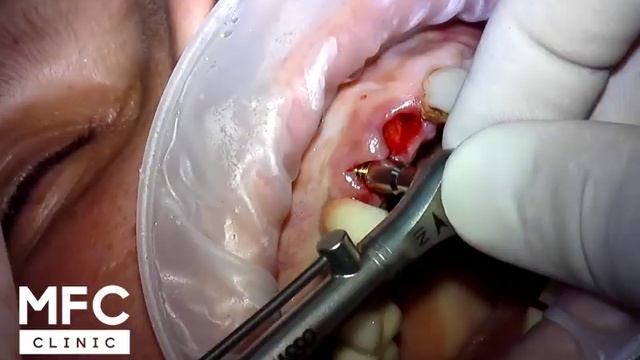 Уделяем два зуба и сразу ставим импланты с временными коронками смотреть онлайн