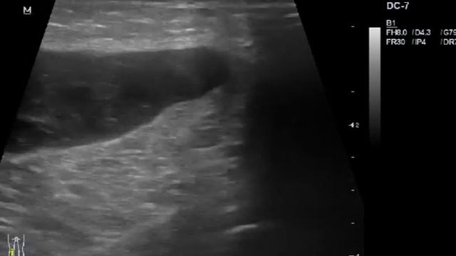 Осложненная киста Беккера смотреть онлайн