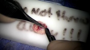 Eardrum Hole Surgery  - Transcanal Tympanoplasty