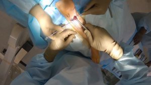 Опухоль на голени у ребенка. Хирургическое удаление!