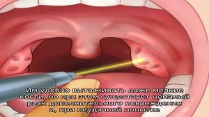 Как вытащить застрявшую кость из горла