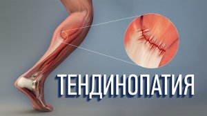 Тендинопатия. Как ее лечить? Что это такое?