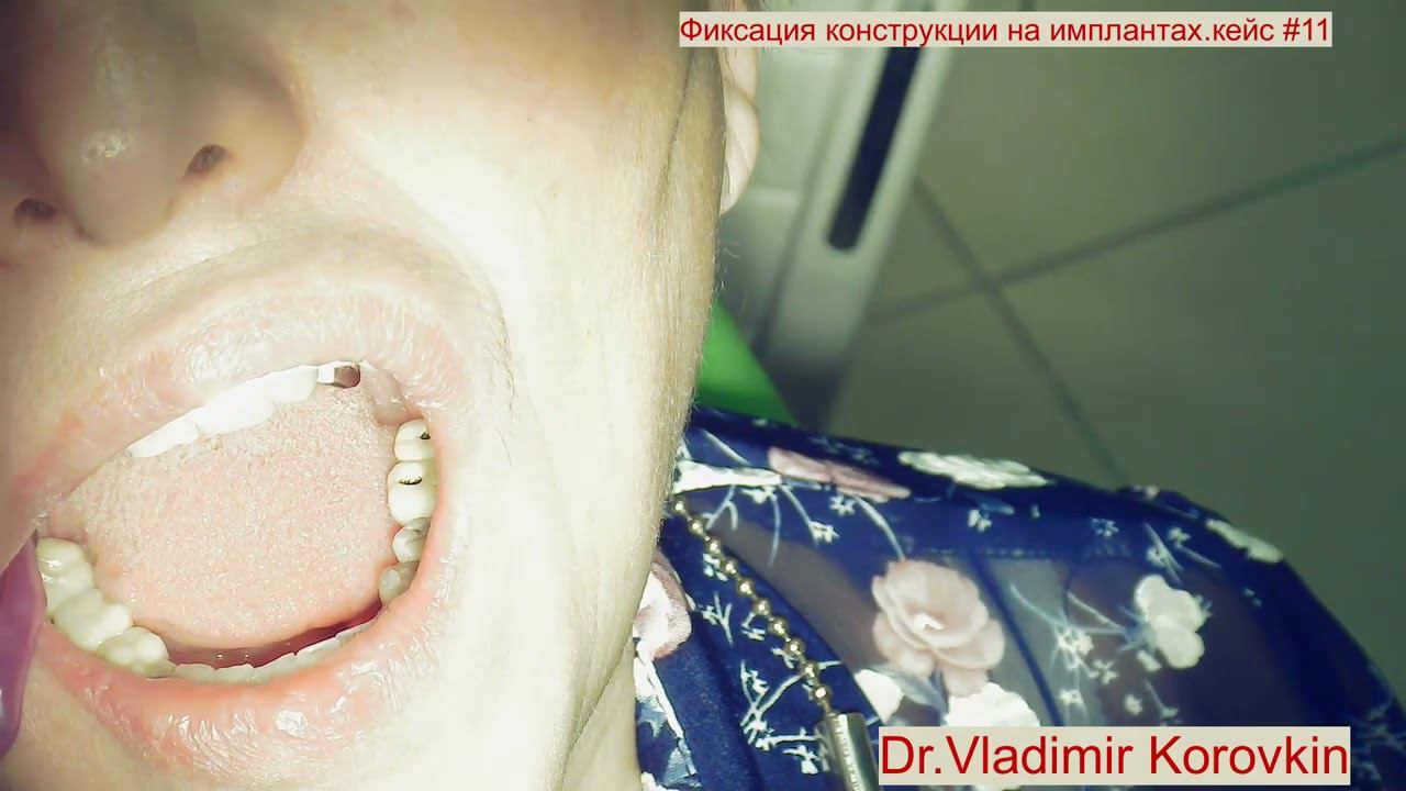 Фиксация коронок на импланте  36,37. Кейс #11.