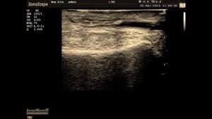 Arterial puncture US giuded \ Пункция артерии под УЗ-контролем