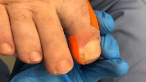 Вросший ноготь??? • Устранение??