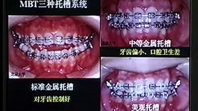 直絲弓矯正技術1 標清 смотреть онлайн