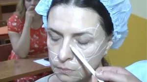 Введение в лицо филлеров/Радиесс - Radiesse/Часть 2.1 Мгновенный результат