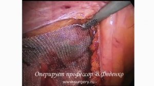 грыжа паховая