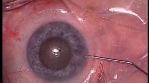 Факоэмульсификация в глазу с узким зрачком. Phacoemulsification in an eye with narrow pupil.