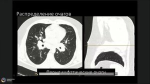 Анатомия легочной дольки, возрастные особенности, варианты нормы 1