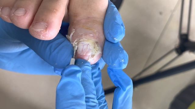 Onychomycosis cleaning treatment, the formation of paronychia【Foot Scalpel】 смотреть онлайн