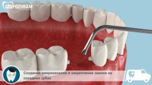 Мостовидные зубные протезы: зубной мост на микрозамках