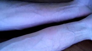 Пчелиный укус. Опухоль, отек и аллергия после укуса. (необходимо приложить холод)