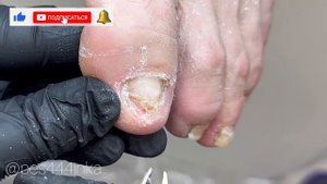 Медицинский педикюр/ грибок ногтей/ педикюр у подолога