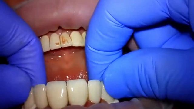 Установка металлокерамических коронок в клинике KRH Medical смотреть онлайн