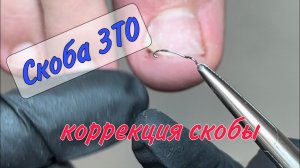 ?ВРОСШИЙ НОГОТЬ _ СКОБА 3ТО _ КОРРЕКЦИЯ СКОБЫ 3ТО