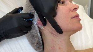 Процедура препаратом Bio-expander, зоны инъецирования шея и декольте.