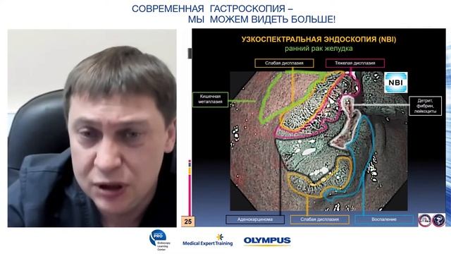 Высокотоехнологичная эндоскопия в диагностике раннего рака желудка смотреть онлайн