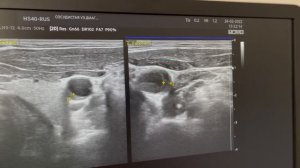 Находка в сонной артерии у мужчины при исследовании сонной артерии. Сосудистый хирург. Флеболог