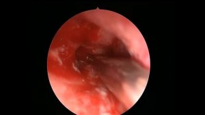 Эндоскопическое удаление грибкового тела гайморовой пазухи