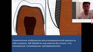 Препарирование зубов под коронки. Основные принципы.