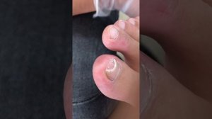 Injured nails that become hollow and require trimming【Foot Scalpel】