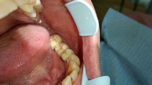 протезирование зубов