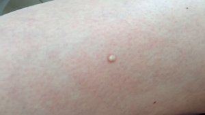 Удаление дерматофибромы