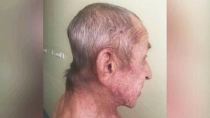Врачам в Новосибирске удалось провести уникальную операцию на позвоночнике