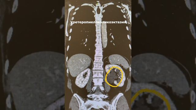 На снимках КТ уретеропиелокаликоэктазия слева