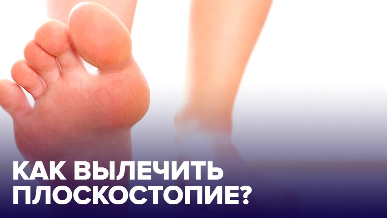 Чем опасно ПЛОСКОСТОПИЕ? Советы подолога