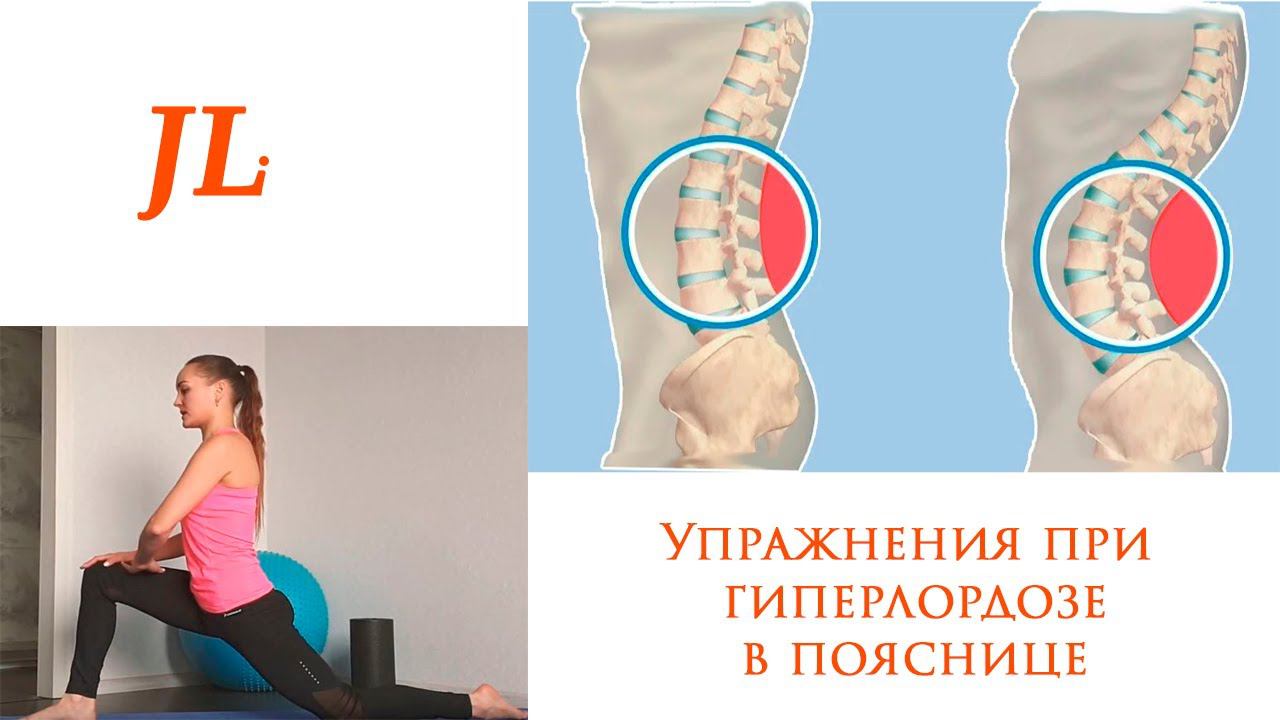 Комлекс упражнений при гиперлордозе в поясничном отделе позвоночника