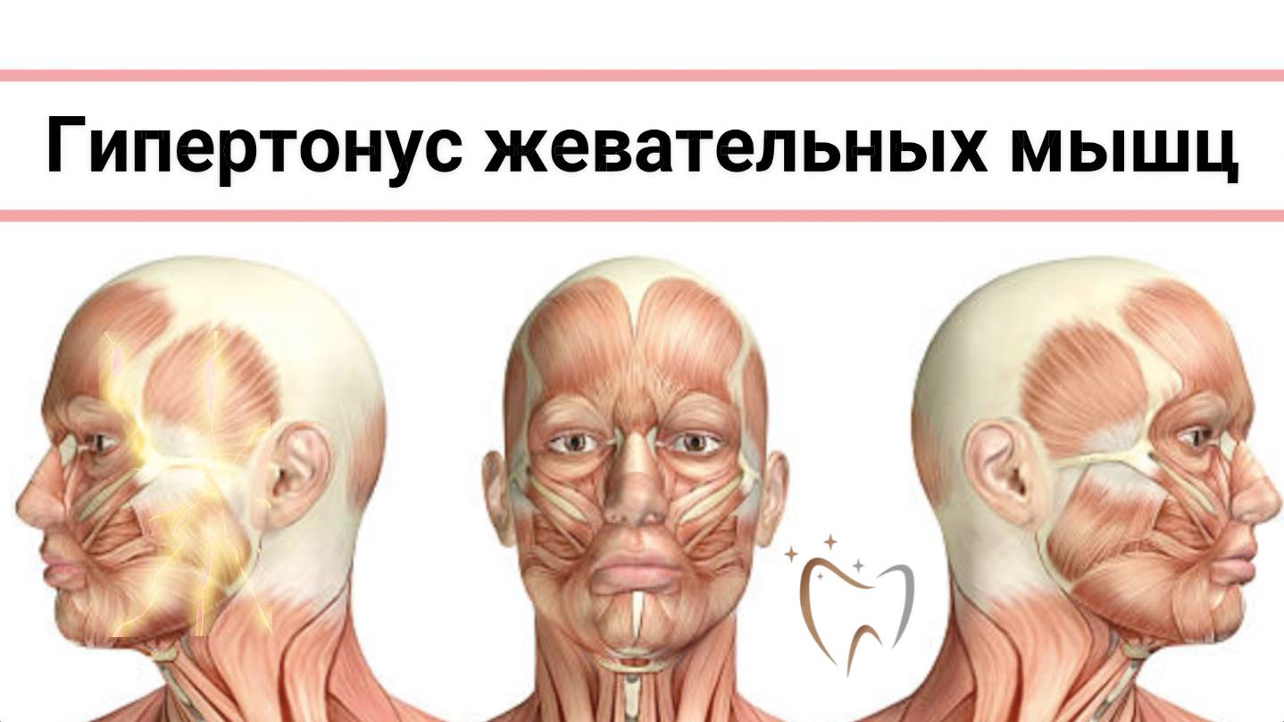 Гипертонус жевательных мышц