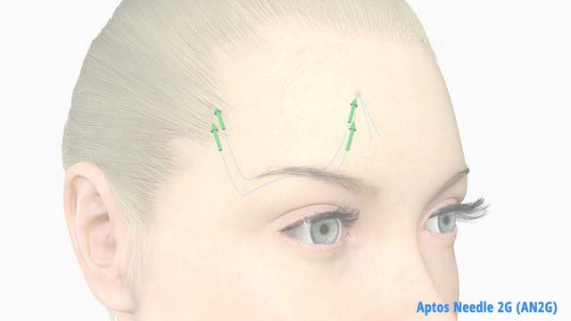 Обучающий курс по нитям для врачей-косметологов | Нити АПТОС