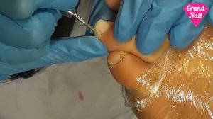 Аппаратный Педикюр Обработка Боковых Валиков Игольчатой Фрезой Этап 5