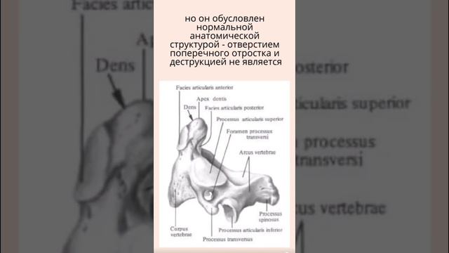 Поперечный отросток позвонка симулирует очаг деструкции