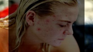 Причины появления АКНЕ. Способы избавиться от УГРЕЙ. Диета при акне. Прыщи на лице у подростков.