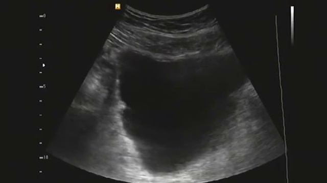 Папиллома мочевого пузыря смотреть онлайн