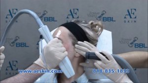 Forever Young BBL IPL Photofacial Demo 46 Andrea Hunt - A E Skin - Encino, CA - 818-835-1833