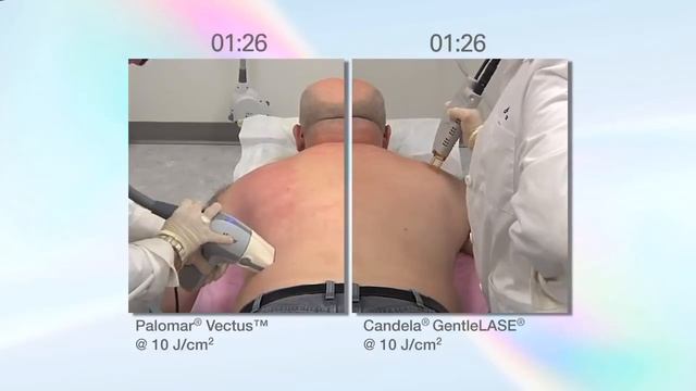 Palomar Vectus - Syneron Candela GentleLase смотреть онлайн